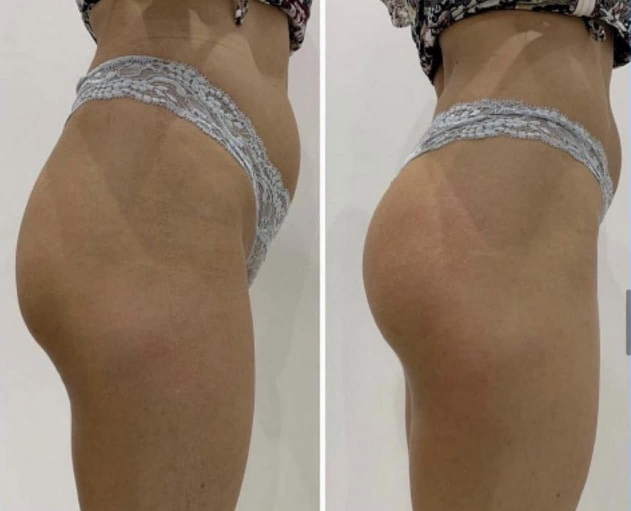 Before and after — Abdomen & Waist