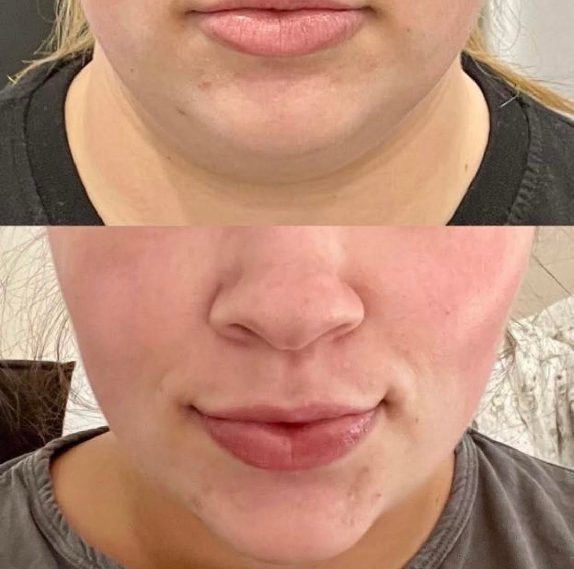 Before and after — Muscle Toning