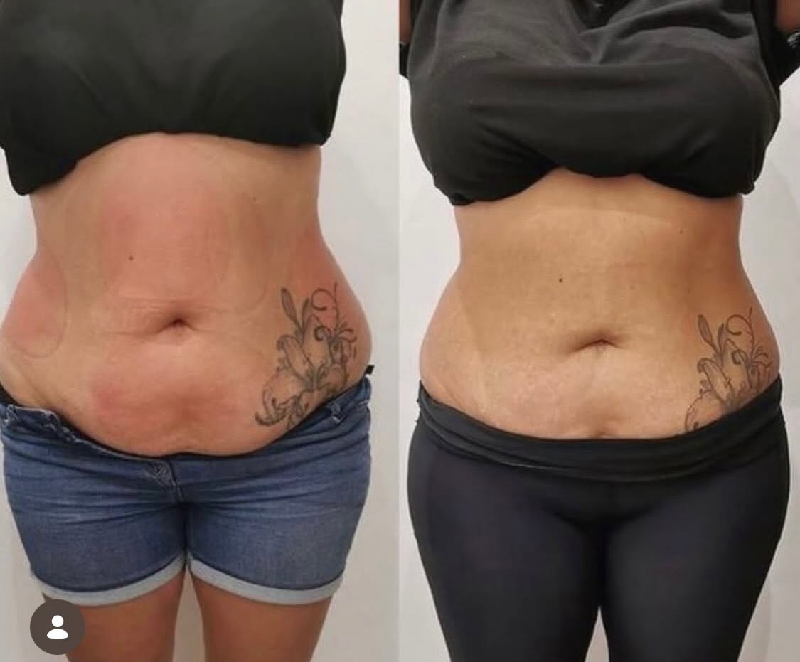 Before and after — Thighs & Hips