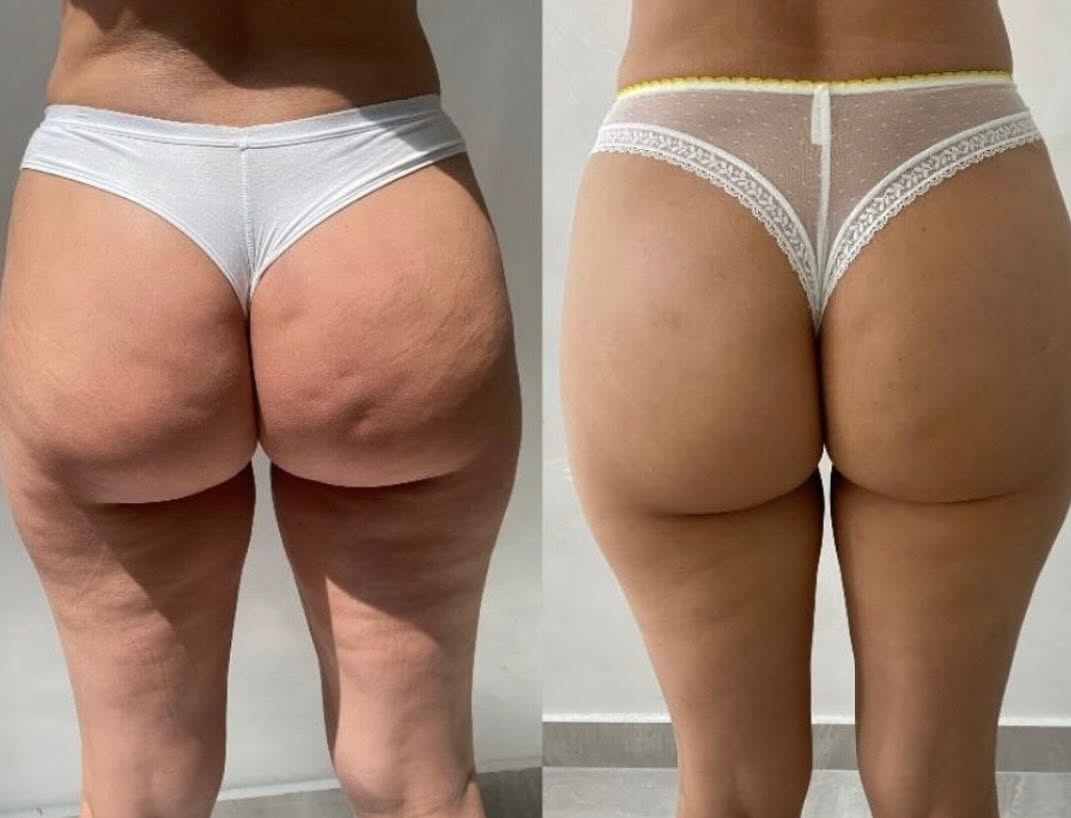 Before and after — Skin Tightening
