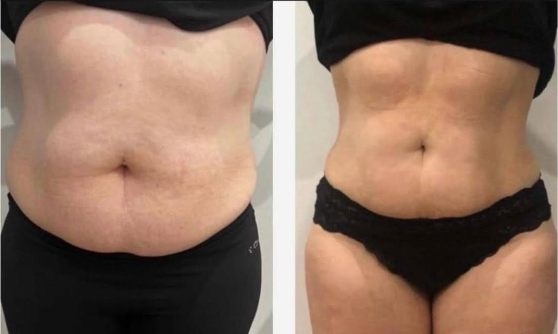 Before and after — Arms & Upper Body