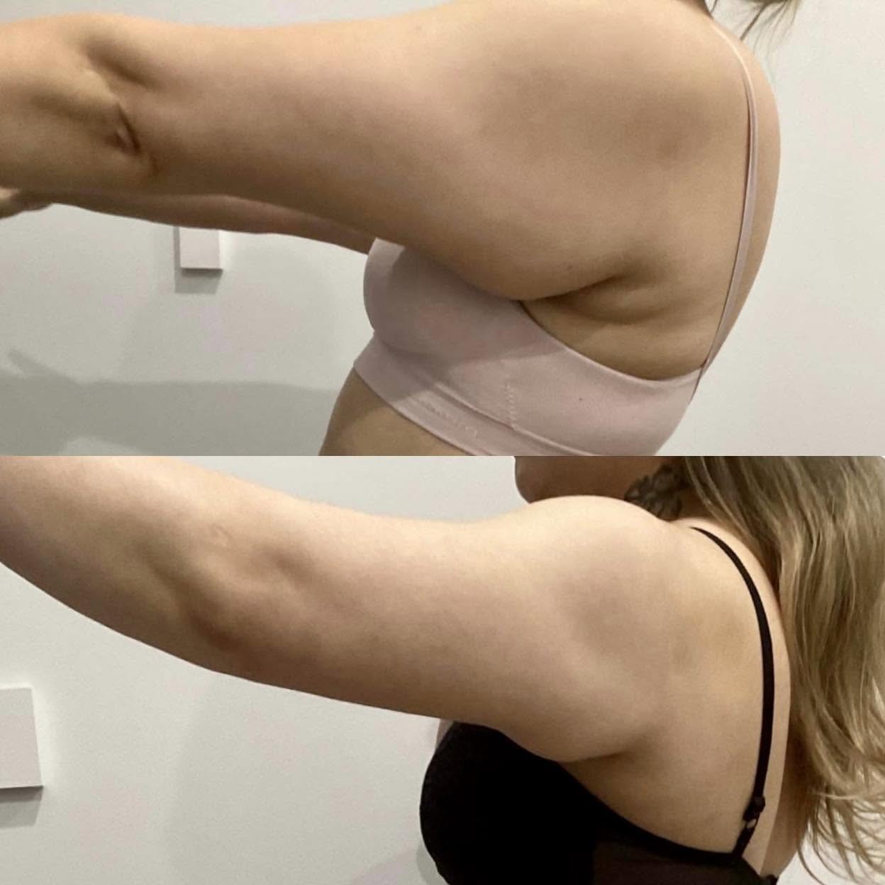 Before and after — Fat Reduction